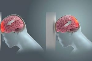 Concussions early in life can cause cognitive decline later — even after you’ve healed