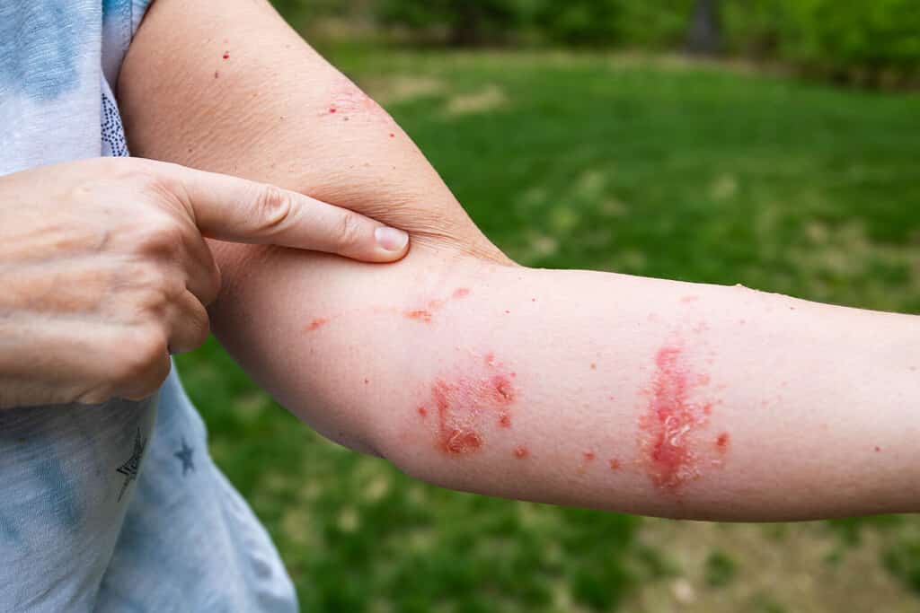 8 Effective Solutions That Kill Poison Ivy Permanently