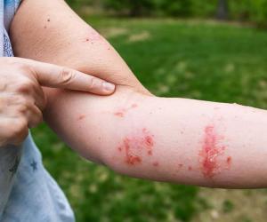 8 Effective Solutions That Kill Poison Ivy Permanently